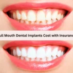 Full Mouth Dental Implants Cost with Insurance