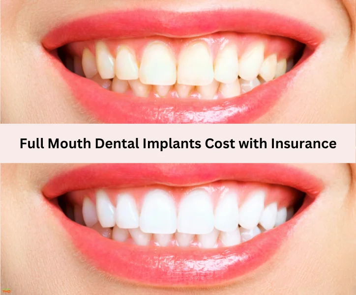 Full Mouth Dental Implants Cost with Insurance